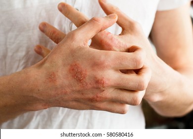 The problem with many people - eczema on hand. White background. Man itchind skin.