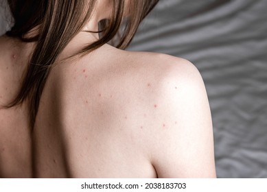 Problem Skin. Young Woman's Back With Acne, Pimples And Red Spots.