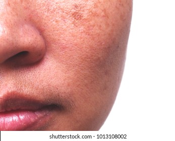 Problem Skincare And  Health Concept. Wrinkles, Melasma  , Dark Spots, Freckles , Dry Skin,pigmentation  On Face Middle Female.