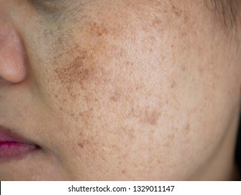 Problem skincare and health concept. Wrinkles, melasma, Dark spots, freckles, dry skin, pigmentation on face asian woman. 