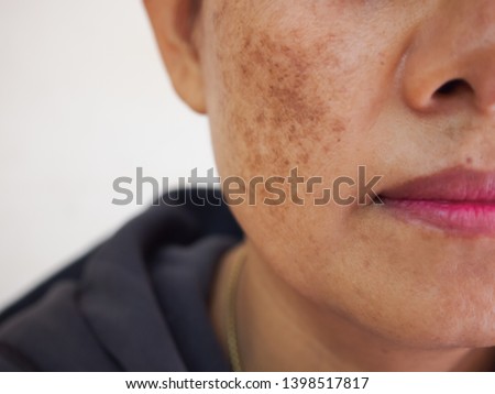 Problem skincare and health concept. Wrinkles, melasma, Dark spots, freckles, dry skin on face middle age woman . 