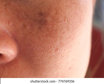 Problem Skincare and health concept.Wrinkles , melasma,freckles, dry skin on middle female face.