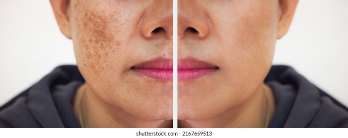 Problem skincare and health concept.Wrinkles,melasma,Dark spots,freckles,dry skin on face middle age woman. Before and after treatment.
