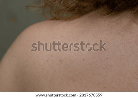 Problematic back skin with acne breakouts and inflamed pimples isolated photo, close-up of acne-prone skin for dermatology and skincare concepts