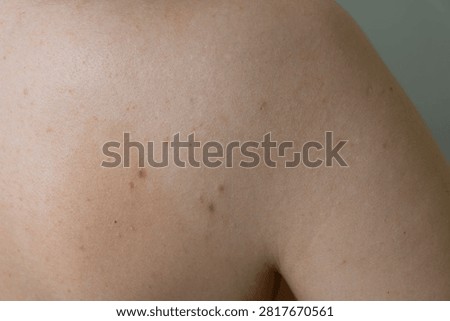 Problematic back skin with acne breakouts and inflamed pimples isolated photo, close-up of acne-prone skin for dermatology and skincare concepts