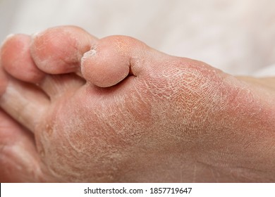 Rough Feet