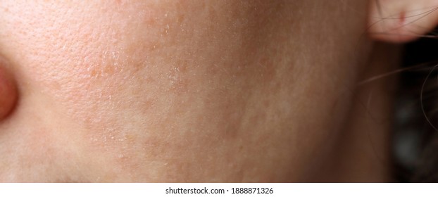 Problematic female facial skin close-up. Skin peeling, acne, adolescence. Peeling of the skin in the cold. - Shutterstock ID 1888871326