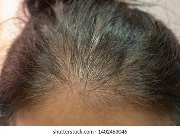 Problematic Skin And Gray Hair In Woman