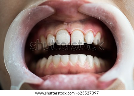 Similar – gap between one’s teeth