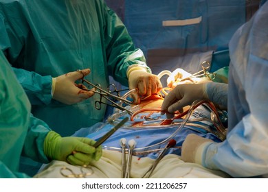 Procedure of coronary artery bypass graft CABG for the operation a heart due to coronary heart disease in an operating room in hospital