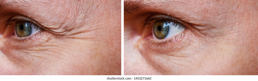 Procedure For The Rejuvenation Of Wrinkles Around The Eyes, Crow