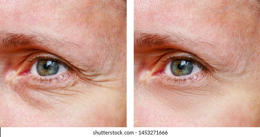 Procedure for the rejuvenation of wrinkles around the eyes, crow