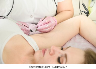 Procedure removal of hair permanently in a woman's underarm using metod electro epilation. Doctor working in cosmetology beauty salon. Close up. Removal of hair permanently using electrolysis.