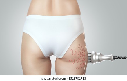 The procedure of rf lifting on the hips and buttocks of women and body fat. Obesity treatment. Cosmetology and skin care.