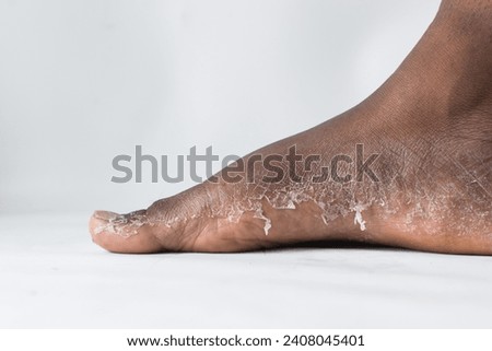 Process of foot peeling, brown skin foot in the process of peeling, skin shedding on a foot
