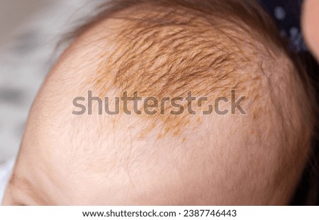 The process of formation of seborrheic dermatitis in an infant on the head. Scaly crusts, close-up