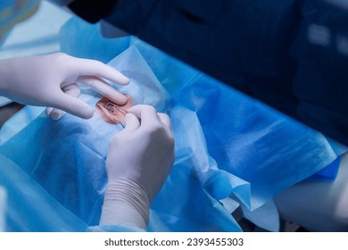 Process laser vision correction, lasik treatment. Doctor use equipment for fixing eyeball, patient under sterile cover.