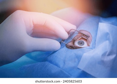 Process laser vision correction, lasik treatment. Doctor use equipment for fixing eyeball, patient under sterile cover.