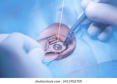 Process laser vision correction, lasik treatment. Doctor use equipment for fixing eyeball, patient under sterile cover.