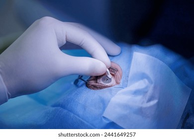 Process laser vision correction, lasik treatment. Doctor use equipment for fixing eyeball, patient under sterile cover.