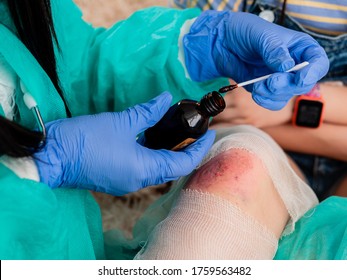 The Process Of Treating The Wound With An Antiseptic. Knee Injury. Close-up