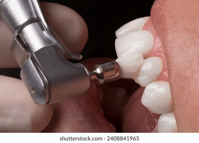 process of using stomatological brush as a stage of professional dental cleaning procedure in clinic close up