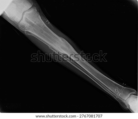Professional computed radiography scan of the human lower extremity showing the long bones and joint articulation. This high-resolution medical X-ray is ideal for orthopedic diagnostics, skeletal anatomy studies, and clinical healthcare presentations.