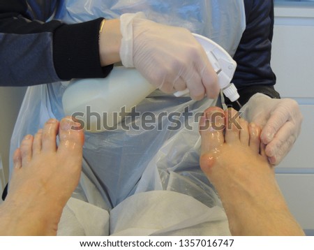 Professional podiatrist uses softening spray to patient´s toes before treatment      