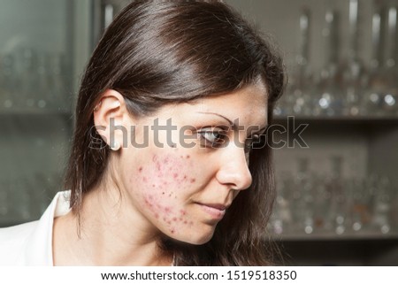 A professional and successful scientist woman is seen with bad acne and skin problems, a side profile view on the cheek of a young girl with problematic spots and scars.