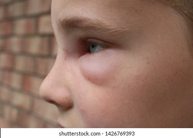 Profile Picture Of A Young Boy With Swelling Of Face Due To Hornet Sting