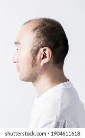 Profile of a thin-haired man