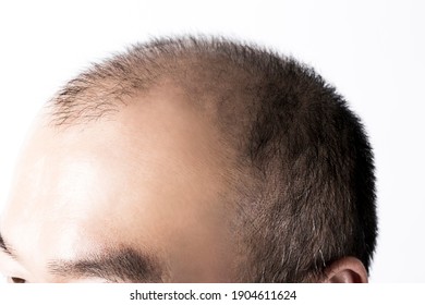Profile of a thin-haired man