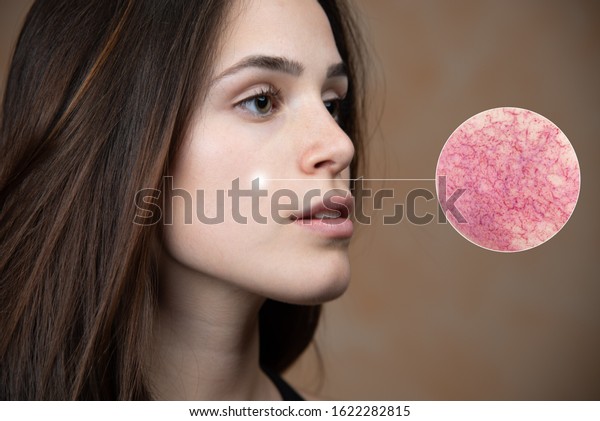 Profile of woman with brown eyes and brown\
hair, microscopic enlargement of the skin of the cheek showing\
dilated capillaries. Rosacea\
manifestation