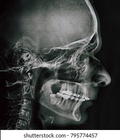 Profile Xray Of Man Jaw For Dentist