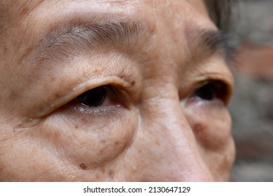 Prominent fat bag under eye of Asian elder woman. Closeup view. - Shutterstock ID 2130647129