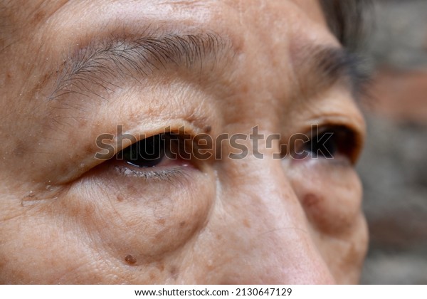 Prominent fat bag under eye of Asian elder woman.\
Closeup view.