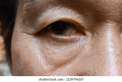 Prominent fat bag and wrinkles under eye of Asian elder man. Closeup view. - Shutterstock ID 2139796107