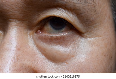 Prominent fat bag and wrinkles under eye of Asian elder man. Closeup view. - Shutterstock ID 2140219175