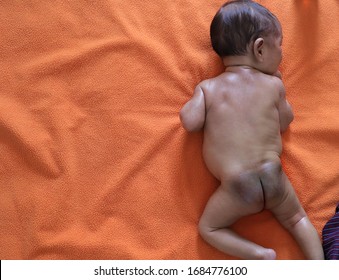 A Prone Infant Lying On His Belly Showing Birth Mark Mongolian Spot In His Buttock. View From Top