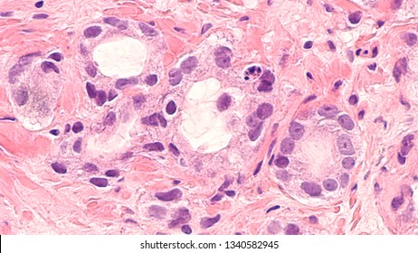 Prostate Cancer Awareness: Photomicrograph (microscopic image) of core biopsy of prostate gland showing histology of adenocarcinoma in patient with elevated PSA.