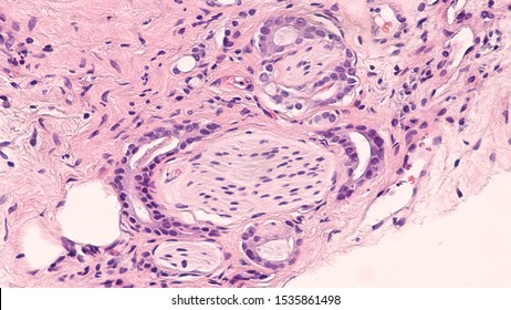 histopatología del adenocarcinoma de próstata