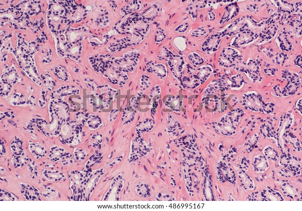 adenoma de próstata salmistas