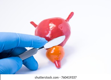 Prostate Gland Surgery Procedure Or Surgical Operation Photo Concept. Hand Surgeon With A Scalpel Is Above The Anatomical Model Of The Prostate And Bladder. Illustration Surgery On The Prostate Gland