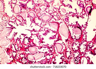 hiperplasia glandular prostatica