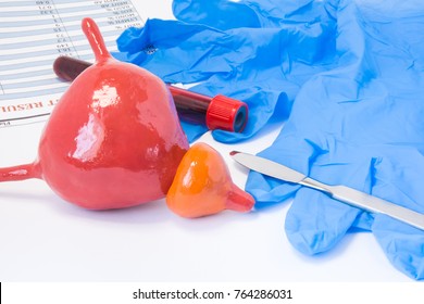 Prostate And Urine Bladder Urology Surgery Concept. Model Of Bladder With Prostate Is Near Scalpel, Surgical Gloves And Blood Test Tube With Blood Result. Indications For Surgery Or Surgical Operation