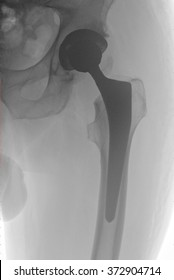 Prosthetic hip joint on roentgenogram