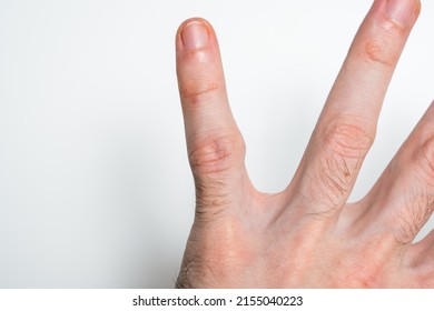 A Protruding Bone On The Finger Of The Hand. Incorrect Bone Fusion. Recovery After A Broken Finger.  Improper Metabolism.