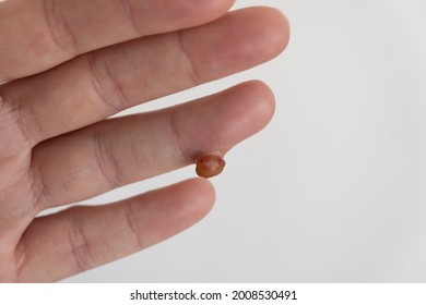 Protruding Soft Tissue Tumor In Finger On White Background