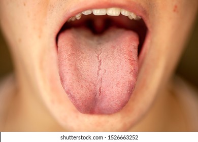 White Coating Tongue High Res Stock Images Shutterstock