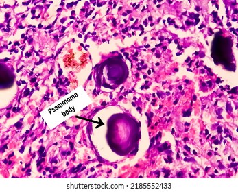 Psammoma Bodies. Spinal Tumor Biopsy. Psammomatous Meningioma.